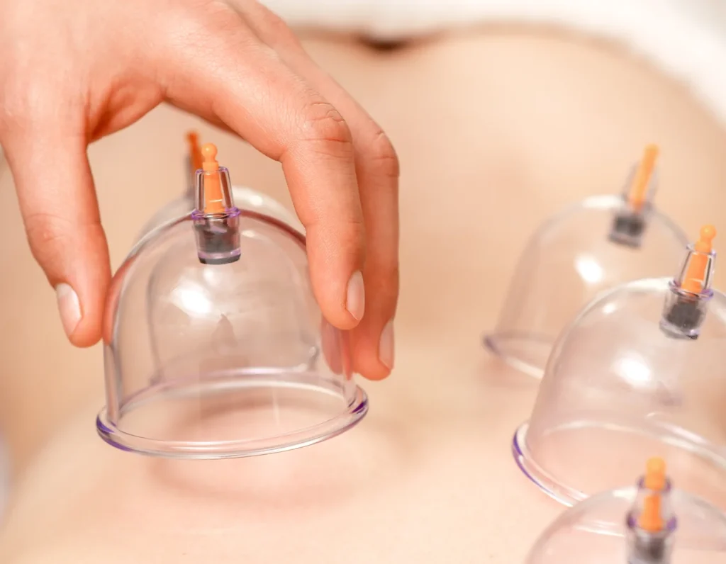 cupping wellness spa